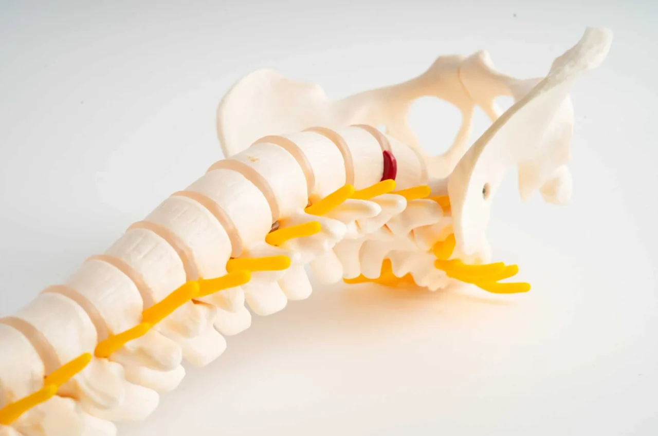Herniated Disc Treatment by a Chiropractor