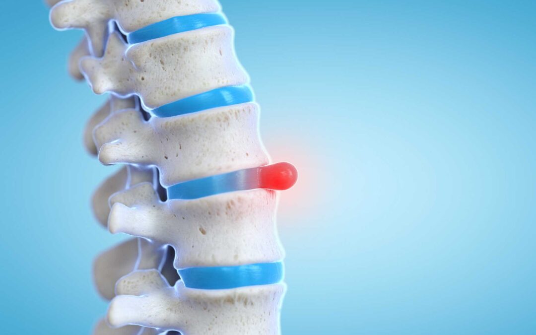 What Causes a Pinched Nerve and How Can Spinal Decompression Help?